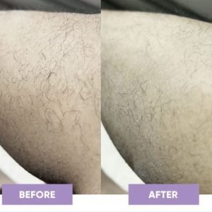 ক্রিস্টাল হেয়ার রিমোভার